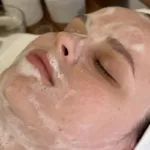 Карбокситерапия