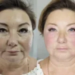 Коллагенотерапия (омоложение биостимуляция)